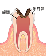 C3：歯髄(神経)に達した虫歯
