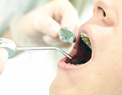 STEP4：除菌後の歯石・歯垢取り